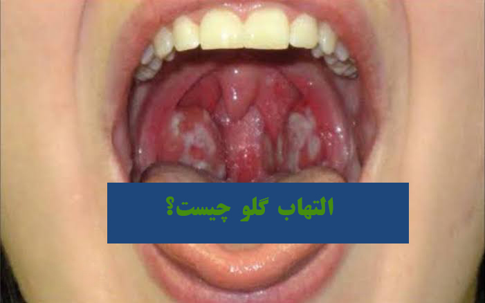 التهاب گلو چیست؟ چگونه درمان می‌شود؟