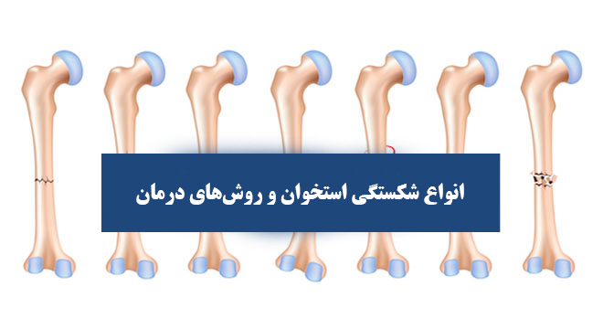 انواع شکستگی استخوان و روش‌های درمان